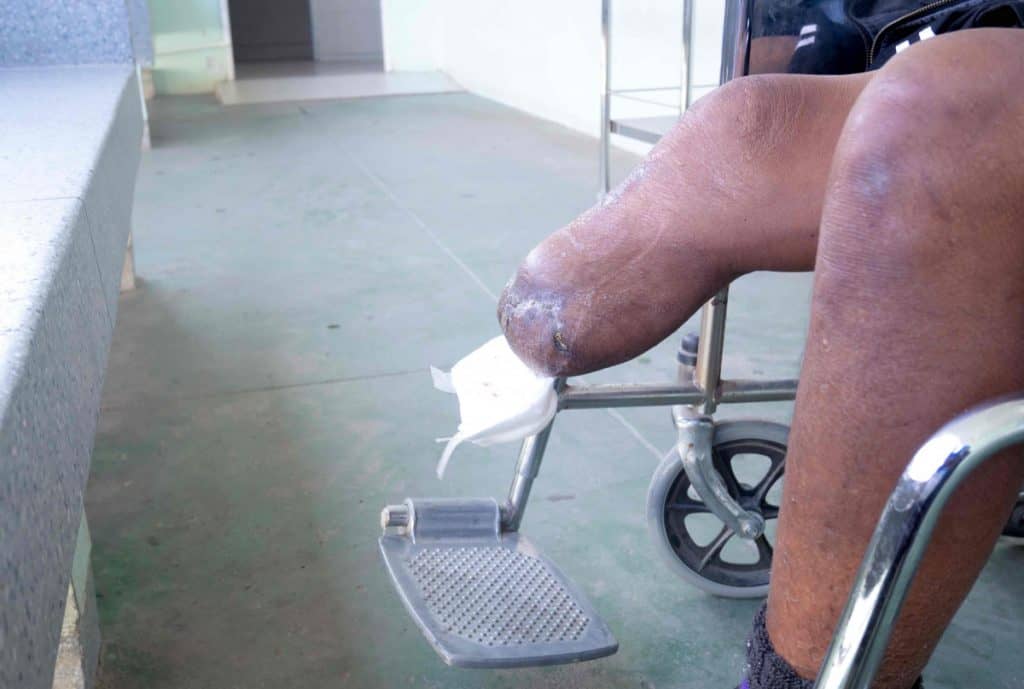 why do diabetics lose limbs