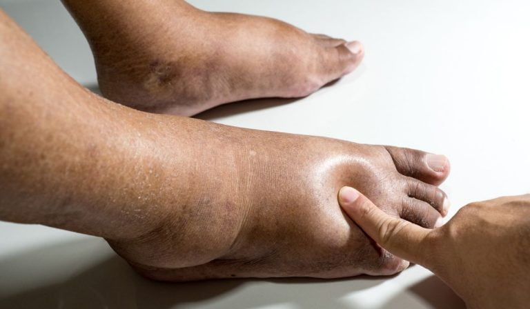 Why Do Diabetics Feet Turn Black? (How To Avoid)