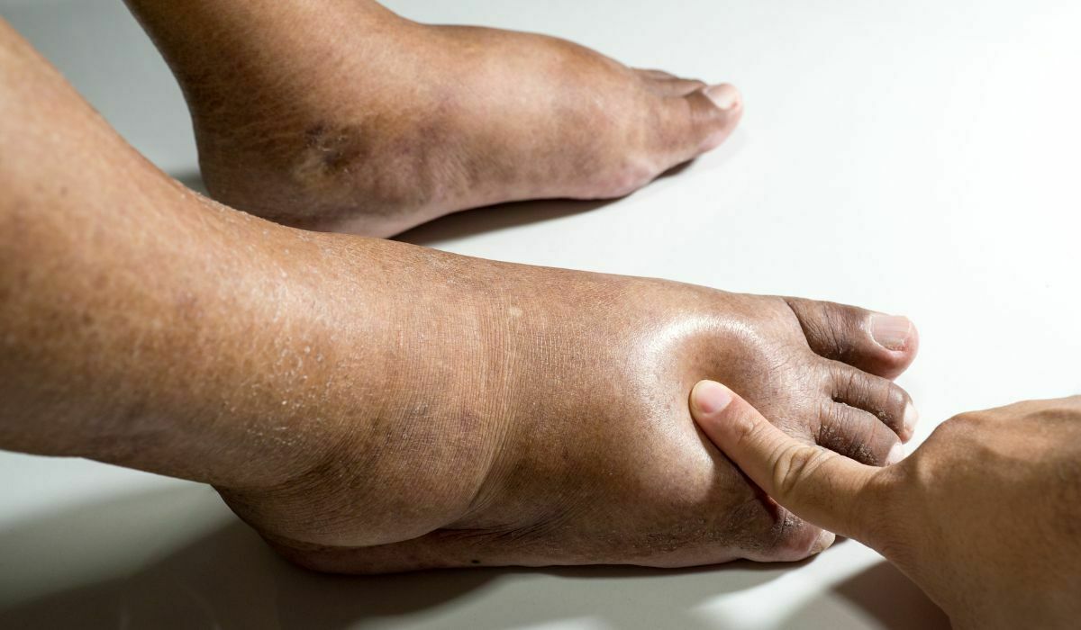 why do diabetics feet turn black